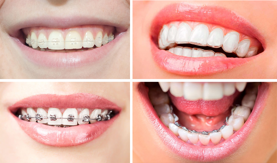 tipos-de-ortodoncia